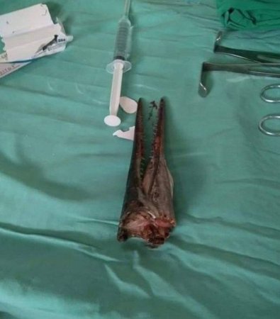 Sudan tullanan balıq oğlanın boynunu deşdi - FOTO Sudan tullanan balıq oğlanın boynunu deşdi - FOTO