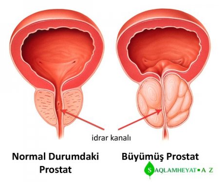 Bu dadlı çərəz prostatı yox edir, cinsi gücü artırır, sonsuzluğu aradan qaldırır...Kişilər üçün xüsusi resept.